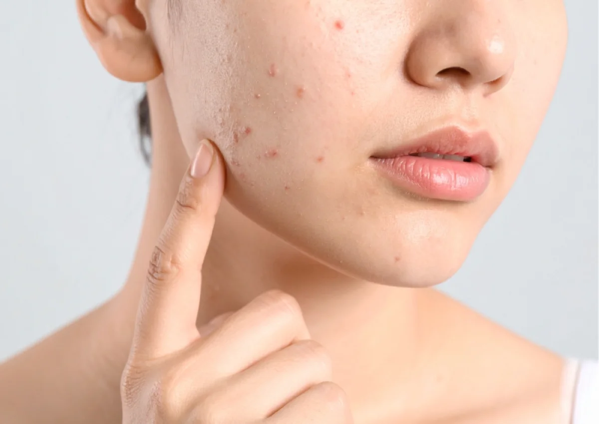 Essential Tips for Protecting Your Skin from Summer Sun and Heat